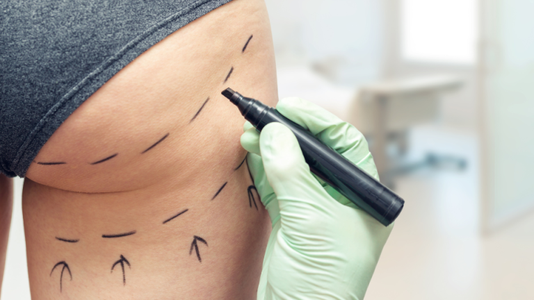 bbl-ghana-cosmetic-procedures-trend