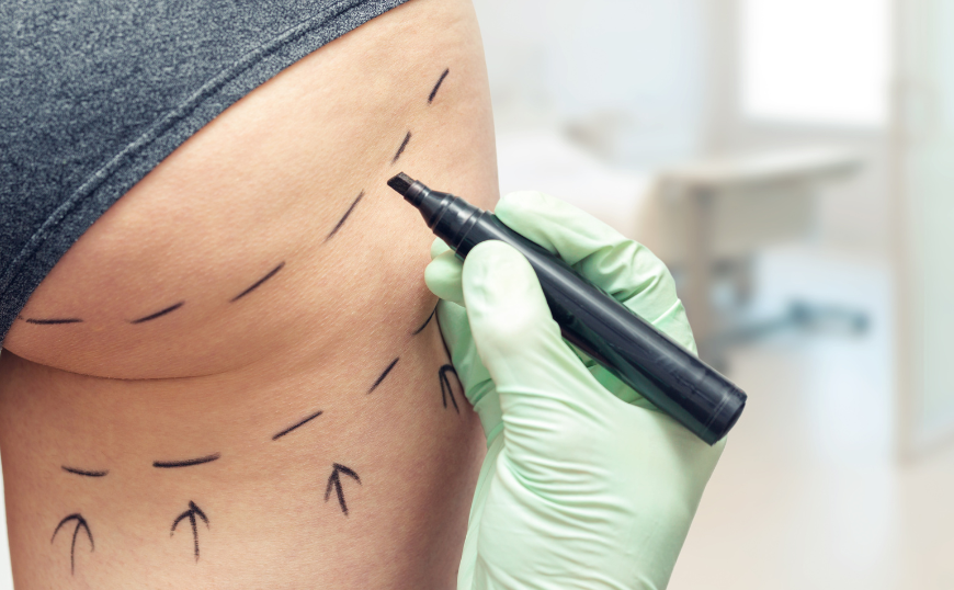 Home bbl-ghana-cosmetic-procedures-trend